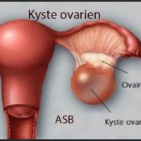 Kystes Ovariens Remède Naturel Contre Kystes ovariens
