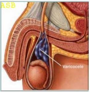 Varicocèle Solution Naturelle Varicocèle