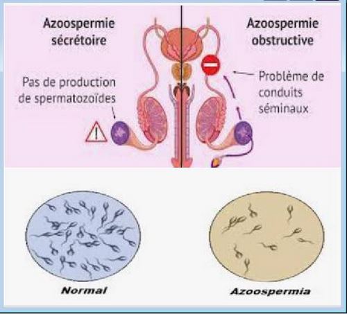 Traitement Infertilité Masculine Maladies du Sperme Examens à Faire