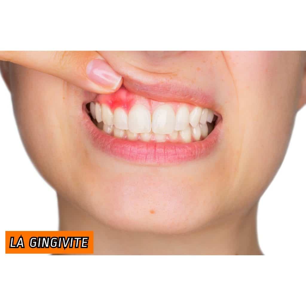 Remede Bio Tres Efficace Pour Guerir De La Gingivite Naturellement
