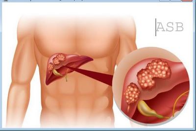 Traitement Naturel Hépatite B Guérir les Hépatites avec les plantes
