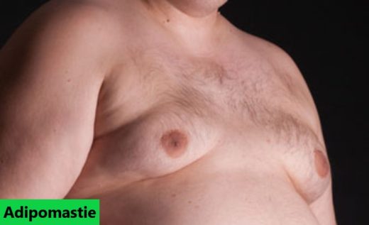 adipomastie