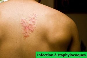 staphylocoque