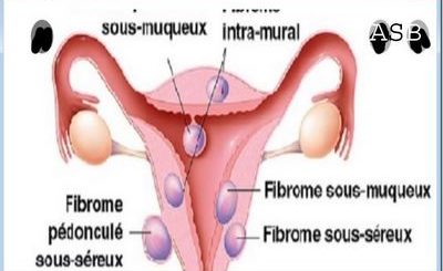 Phytothérapie Fibrome Traitement naturel pour Fibrome utérin