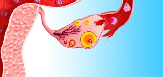 syndrome du follicule lutéinisé