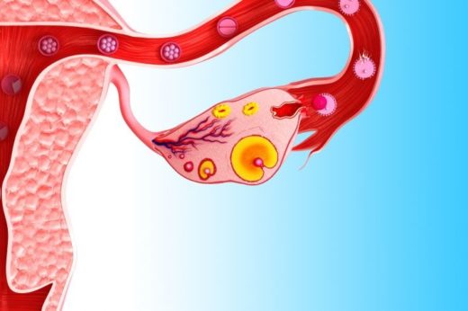 syndrome du follicule lutéinisé