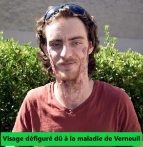 maladie de Verneuil