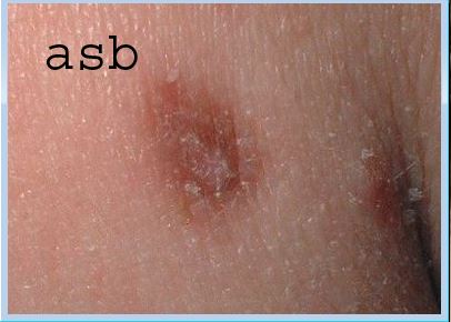 SYPHILIS DEFINITION CAUSES SYMPTOMES TRAITEMENTS