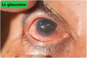 glaucome