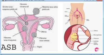 Graines de Lin et Fibrome Remède Naturel Fibrome Utérin