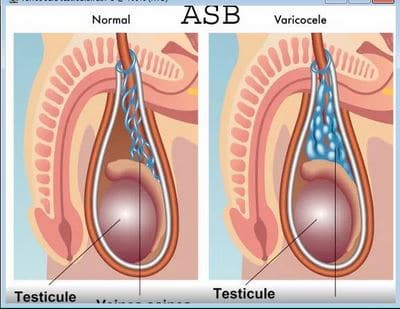Varicocèle testiculaire : Définition Symptômes Traitement Varicocèle