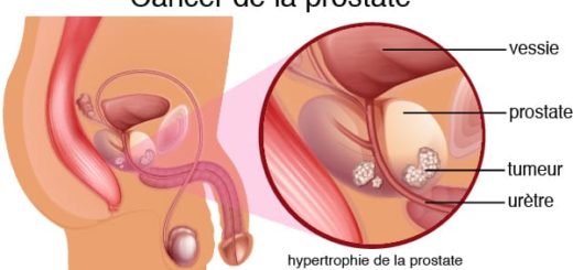 cancer de la prostate