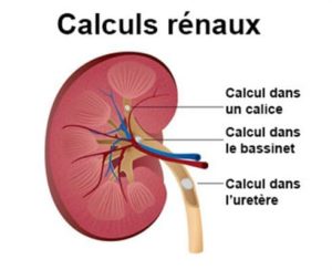 calculs rénaux