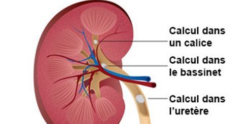 calculs rénaux