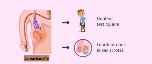 Varicocèle Solution Naturelle Varicocèle