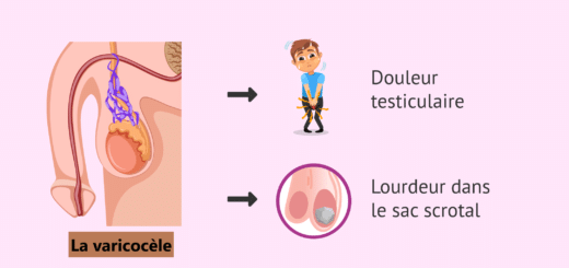 Varicocèle Solution Naturelle Varicocèle