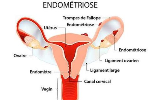 endométriose