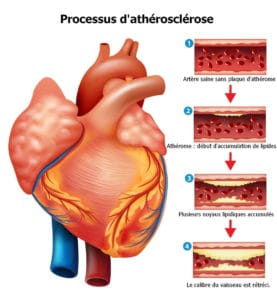 athérosclérose