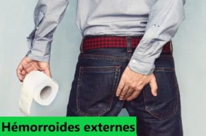 hémorroïdes externe