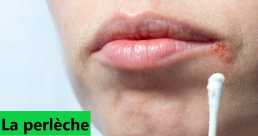 perlèche