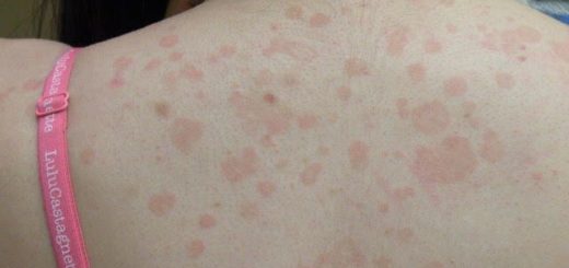 Pityriasis Versicolor Traitement Naturel