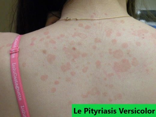 Pityriasis Versicolor Traitement Naturel