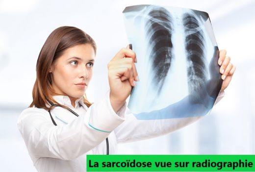 sarcoïdose