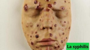 syphilis traitement naturel
