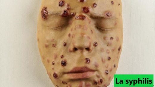 syphilis traitement naturel