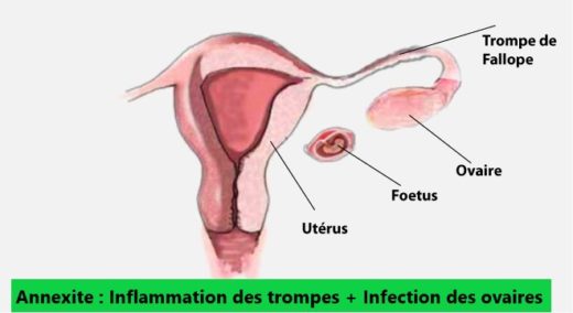 Annexite Traitement Naturel