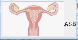 Traitement Naturel Pour Endométriose