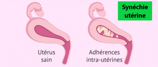 Je suis arrive à tomber enceinte avec une synéchie utérine