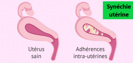 Je suis arrive à tomber enceinte avec une synéchie utérine