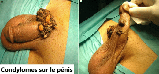 Condylomes, Crètes de coq, Verrues Génitales Traitement Naturel