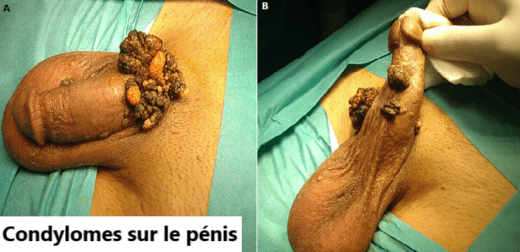 Condylomes, Crètes de coq, Verrues Génitales Traitement Naturel