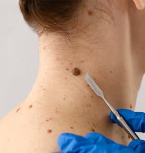 Histiocytofibrome Traitement Naturel, Dermatofibromes, Crème