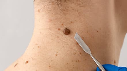 Histiocytofibrome Traitement Naturel, Dermatofibromes, Crème