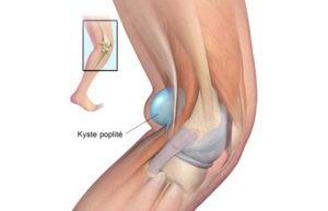Kyste Poplités Traitement Naturel par les Plantes