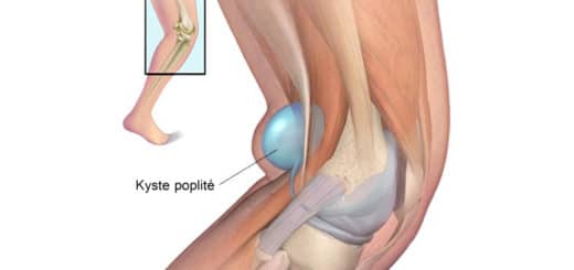 Kyste Poplités Traitement Naturel par les Plantes