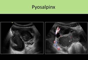 Pyosalpinx Traitement Naturel