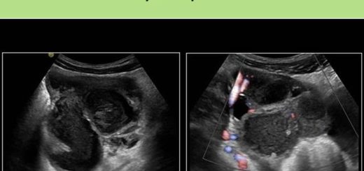 Pyosalpinx Traitement Naturel