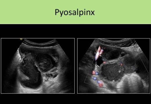 Pyosalpinx Traitement Naturel