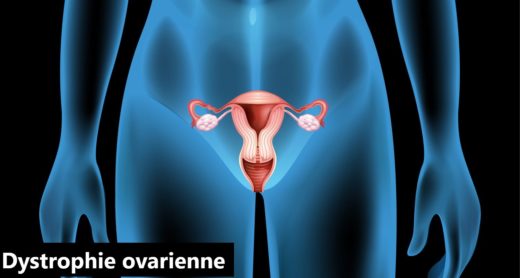 Traitement Naturel Dystrophie Ovarienne plantes. Dystrophie et Grossesse. Guérison totale