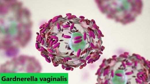 Gardnerella vaginalis traitement naturel. Soigner gardnerella naturellement