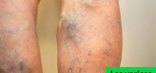 Les varices traitement naturel en arabe