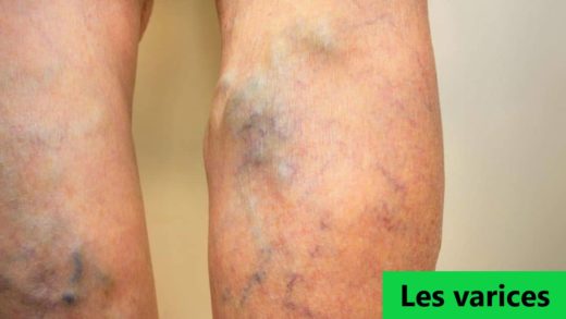 Les varices traitement naturel en arabe