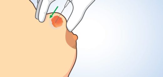 nodule mammaire traitement naturel. nodule mammaire qui grossit