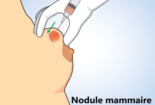 nodule mammaire traitement naturel. nodule mammaire qui grossit