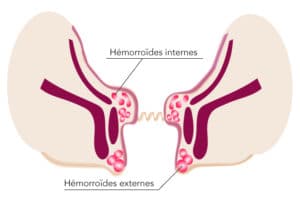plantes pour hémorroides. Hémorroïdes traitement africain