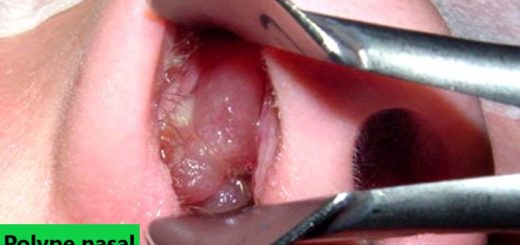 Traitement naturel polype nasal. Soigner les polypes nasales avec le thym